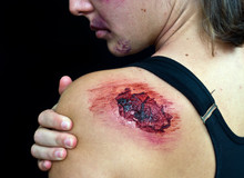 Open Wound On Woman Shoulder