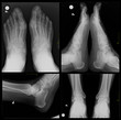 X-ray foot