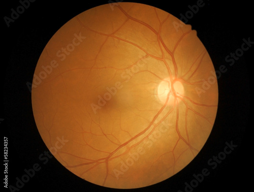 Fotomural Medical photo retina and optic nerve