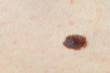 Brown birthmark (nevus) on Caucasian woman leg.
