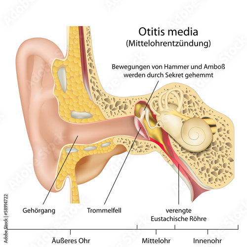 Fototapeta na wymiar Mittelohrentzündung, Erklärung deutsch