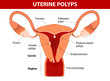 Endometrial polyp or uterine polyp