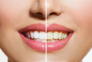 Wall Mural - Woman Teeth Before and After Whitening. Oral Care