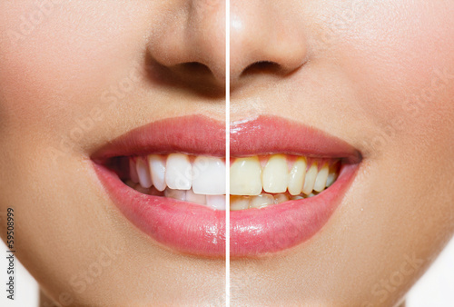 Fotografía Woman Teeth Before and After Whitening. Oral Care