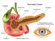 cancro del pancreas