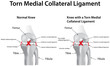 Torn Medial Collateral Ligament