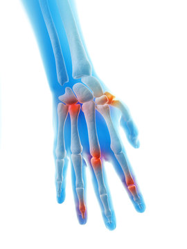 rendered illustration of inflamed finger bones