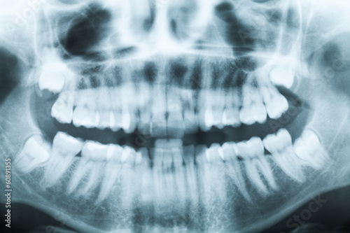Fotografie, Obraz X-ray image of teeth and mouth with four molars