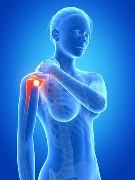 medical 3d illustration - woman having a painful shoulder