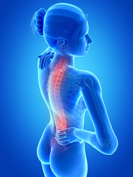 medical 3d illustration - female having backache