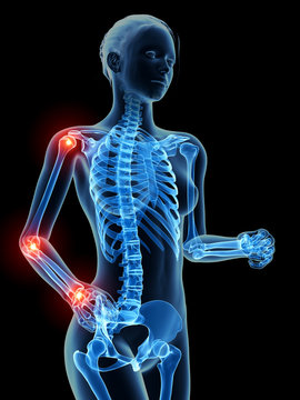 medical 3d illustration - woman having painful joints