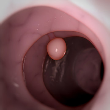medical 3d illustration - colon polyp
