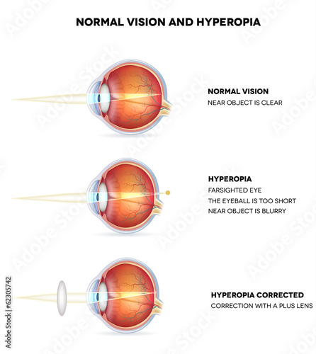 Naklejka ścienna Hyperopia and normal vision. Hyperopia is being farsighted.