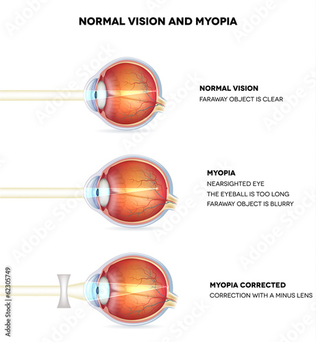 Cuadros en Lienzo Myopia and normal vision. Myopia is being shortsighted.