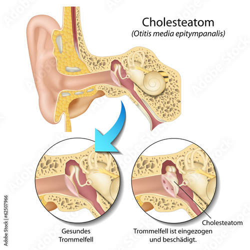 Nowoczesny obraz na płótnie Cholesteatom, Otitis media epitympanalis