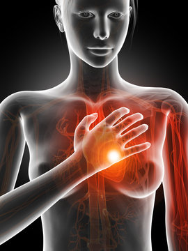 medical illustration - woman having a heart attack