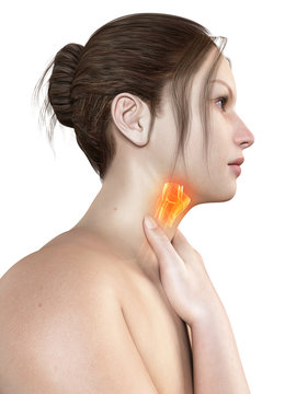 medical illustration of a female with an inflamed larynx