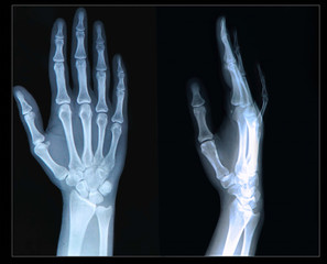 Xray of Hand/ fingers