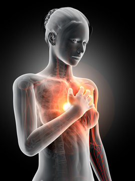 medical illustration - woman having a heart attack
