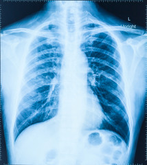 X-Ray Image Of Human Chest for a medical diagnosis