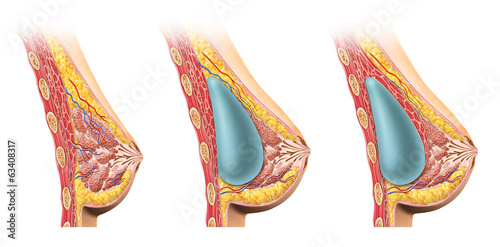Obraz w ramie Woman breast implant cross section.