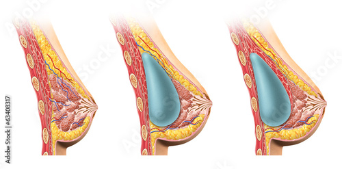 Naklejka - mata magnetyczna na lodówkę Woman breast implant cross section.