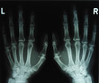 Röntgenbild Hände2