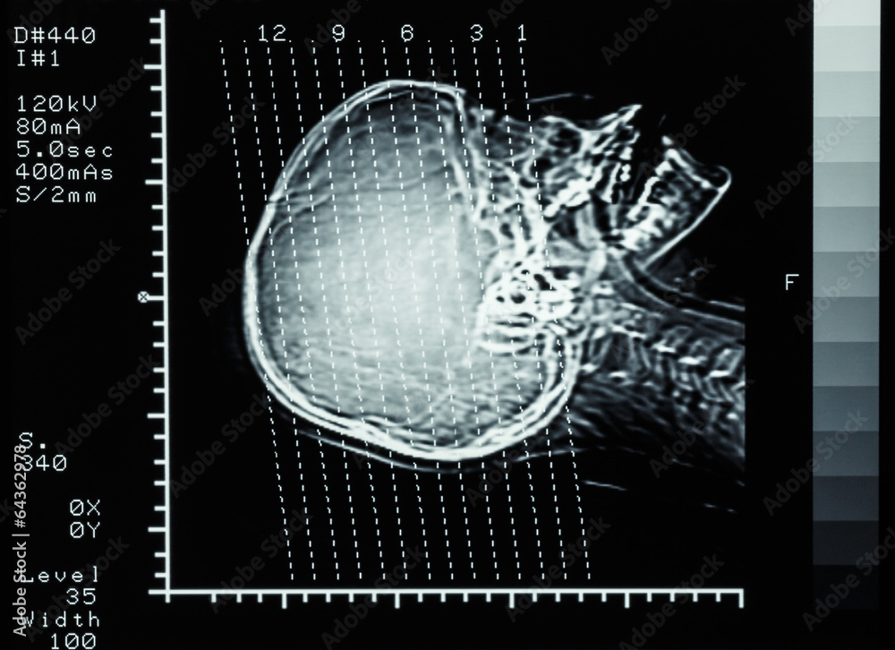 Ct Scan Brainline film CT scan (Computed tomography) brain : show section line on Stock ...