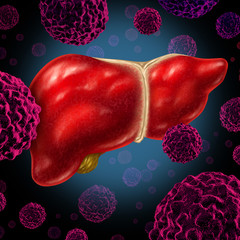 Wall Mural - human liver cancer