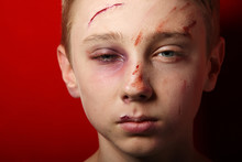 Scarred Beaten Up Kid