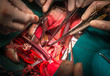 close ventricular septal defect via tricuspid valve