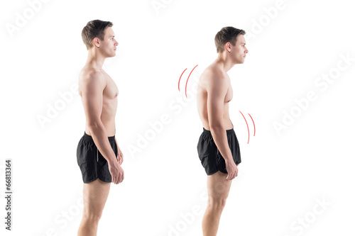 Cuadros en Lienzo Man with impaired posture position defect scoliosis and ideal