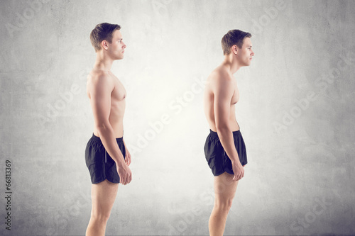 Cuadros en Lienzo Man with impaired posture position defect scoliosis and ideal