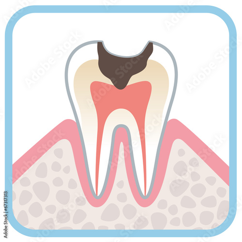歯の断面図 虫歯 Stock イラスト Adobe Stock