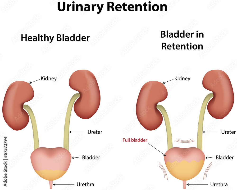 Urinary Retention Stock Illustration | Adobe Stock