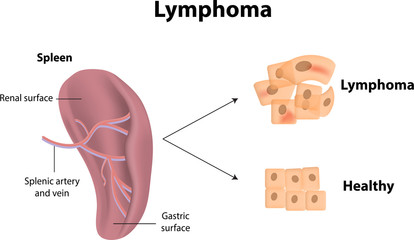 lymphoma