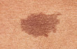 Close-up of brown birthmark