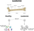 Leukemia Bone