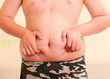 © Elroi - boy 11 years ill obese. metabolic disorder