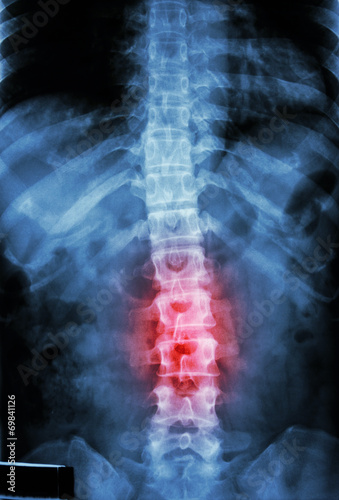 Fotografía human's thoracic-lumbar spine and inflammation at lumbar spine