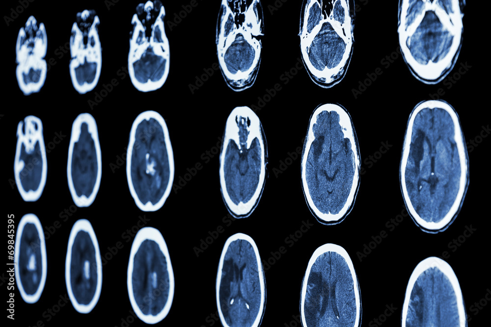 CT scan of brain show ischemic stroke and hemorrhagic stroke Stock ...