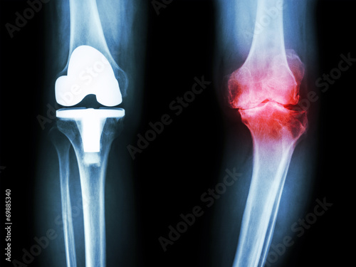 Fotografiet osteoarthritis knee patient and artificial joint