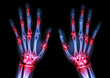 arthritis at multiple joint of hands (Gout,Rheumatoid)