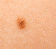 mole on the human skin