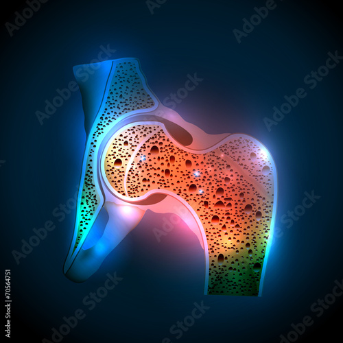 Fotografía Human hip joint and Osteoporosis