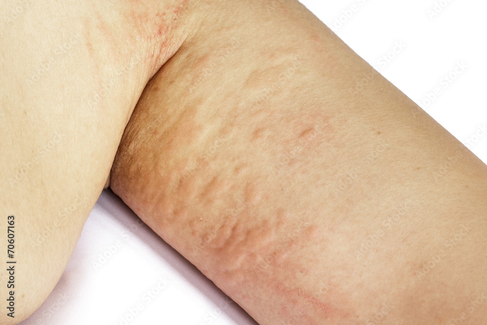 allergic rash skin of patient arm