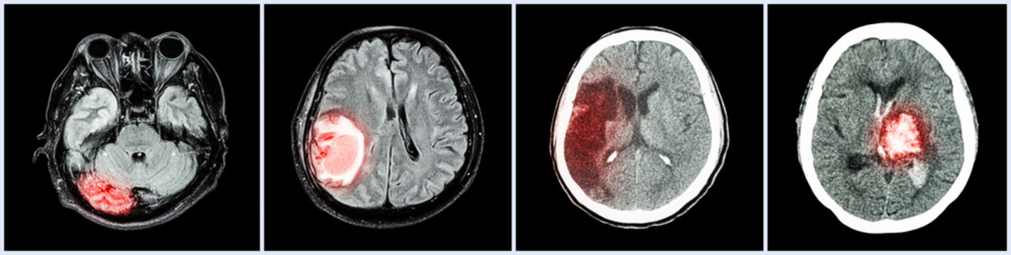 Fototapete - Collection CT scan of brain and multiple disease