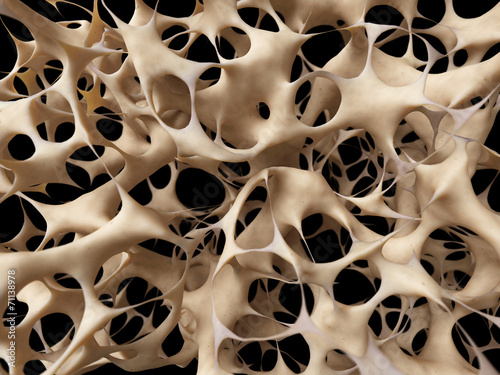 Cuadros en Lienzo osteoporosis - unhealthy bone structure