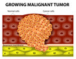 growing malignant tumor
