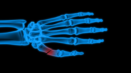 X-ray hand